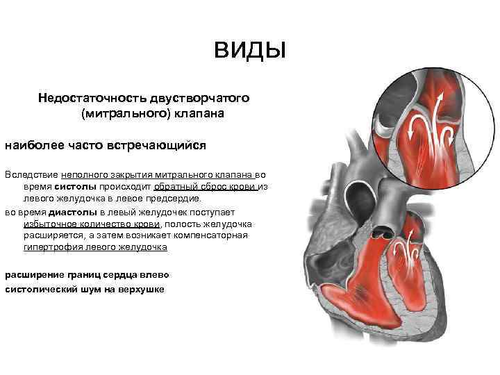 виды Недостаточность двустворчатого (митрального) клапана наиболее часто встречающийся Вследствие неполного закрытия митрального клапана во