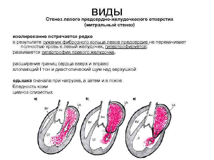 виды Стеноз левого предсердно-желудочкового отверстия (митральный стеноз) изолированно встречается редко в результате сужения фиброзного