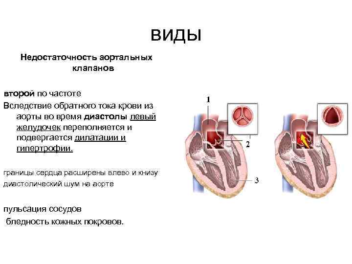 виды Недостаточность аортальных клапанов второй по частоте Вследствие обратного тока крови из аорты во