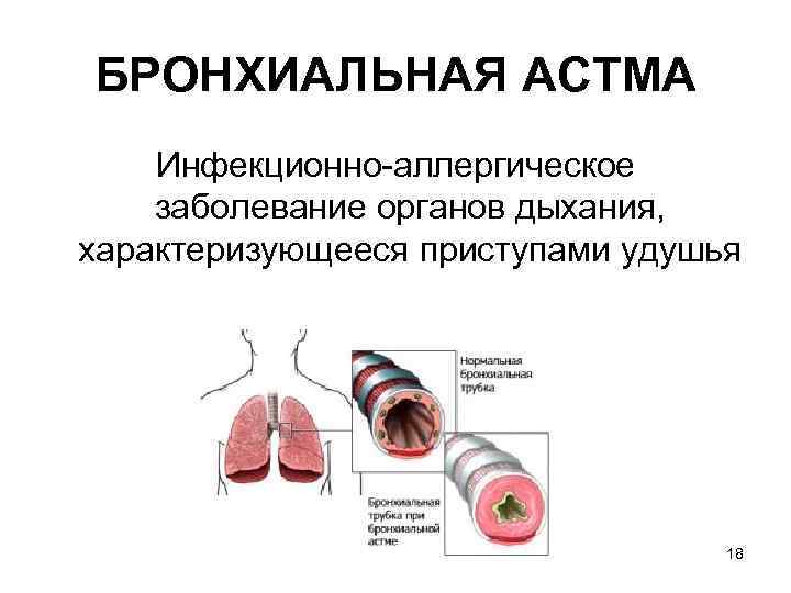 БРОНХИАЛЬНАЯ ACTМA Инфекционно аллергическое заболевание органов дыхания, характеризующееся приступами удушья 18 