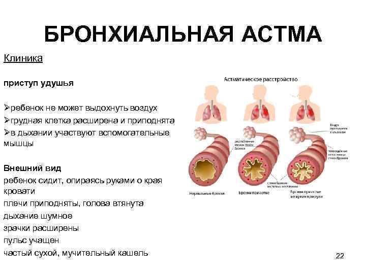 БРОНХИАЛЬНАЯ ACTМA Клиника приступ удушья Øребенок не может выдохнуть воздух Øгрудная клетка расширена и