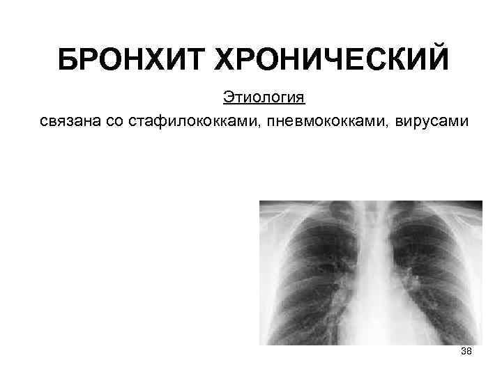 БРОНХИТ ХРОНИЧЕСКИЙ Этиология связана со стафилококками, пневмококками, вирусами 38 