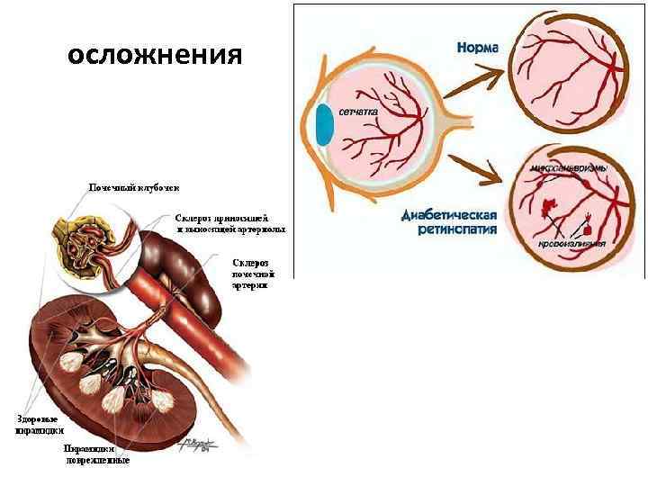 осложнения 