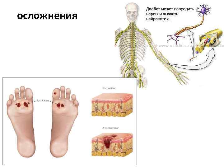 осложнения 