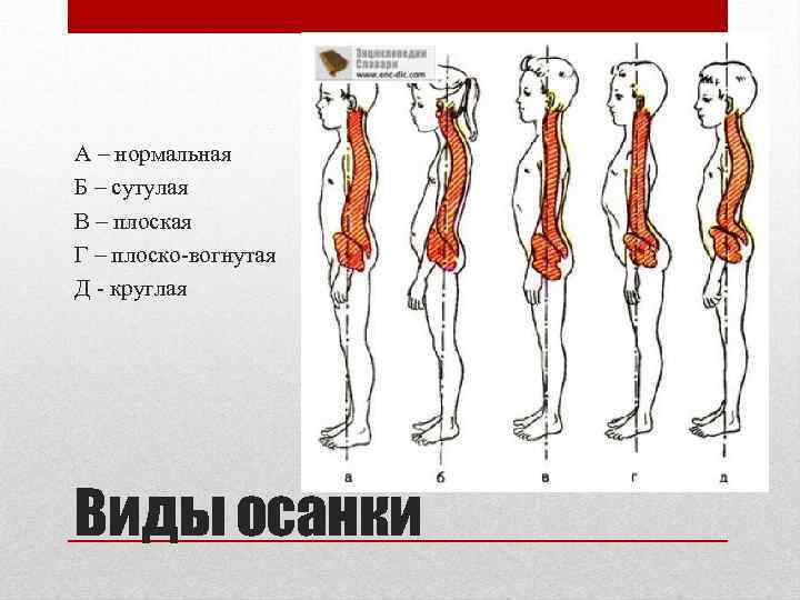 А – нормальная Б – сутулая В – плоская Г – плоско-вогнутая Д -