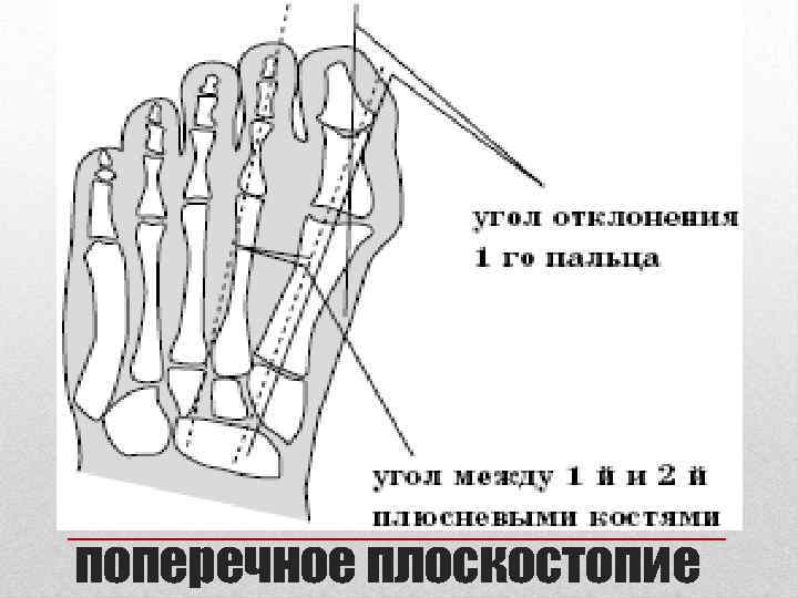 поперечное плоскостопие 