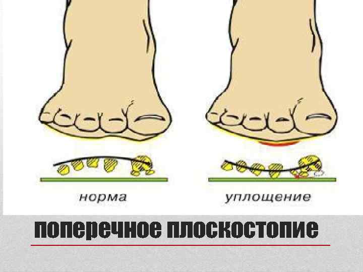 поперечное плоскостопие 