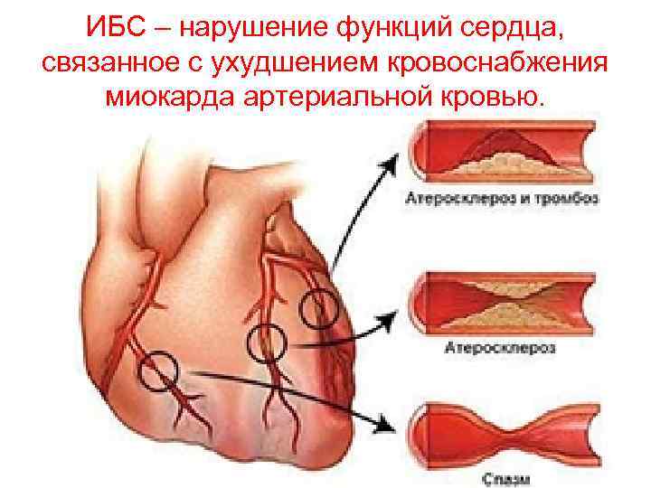 ИБС – нарушение функций сердца, связанное с ухудшением кровоснабжения миокарда артериальной кровью. 