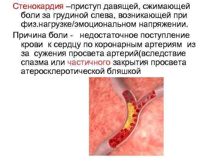 Стенокардия –приступ давящей, сжимающей боли за грудиной слева, возникающей при физ. нагрузке/эмоциональном напряжении. Причина