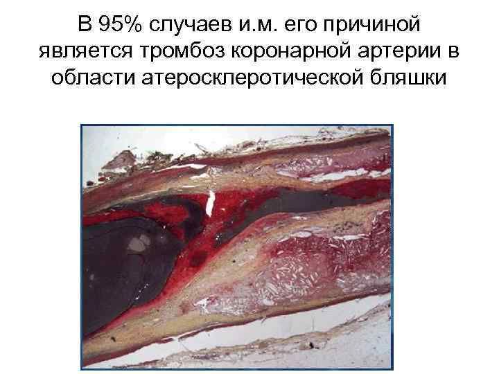 В 95% случаев и. м. его причиной является тромбоз коронарной артерии в области атеросклеротической