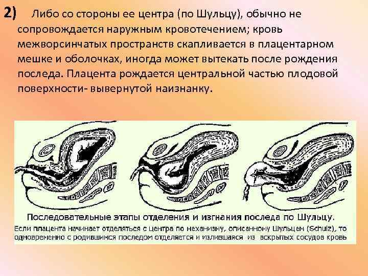 2) Либо со стороны ее центра (по Шульцу), обычно не сопровождается наружным кровотечением; кровь