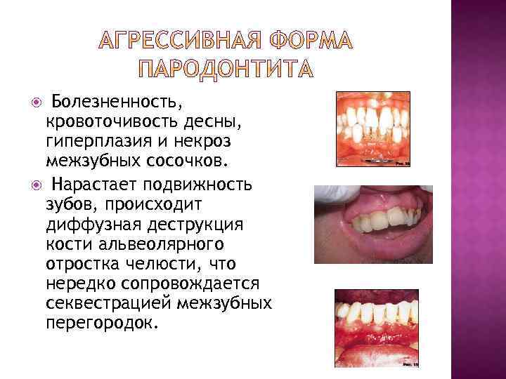 Болезненность, кровоточивость десны, гиперплазия и некроз межзубных сосочков. Нарастает подвижность зубов, происходит диффузная деструкция