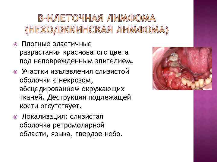 Плотные эластичные разрастания красноватого цвета под неповрежденным эпителием. Участки изъязвления слизистой оболочки с некрозом,