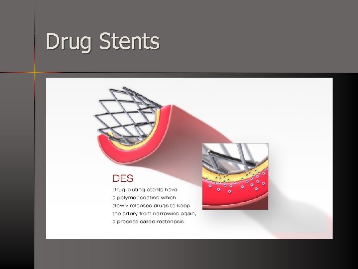 Drug Stents 