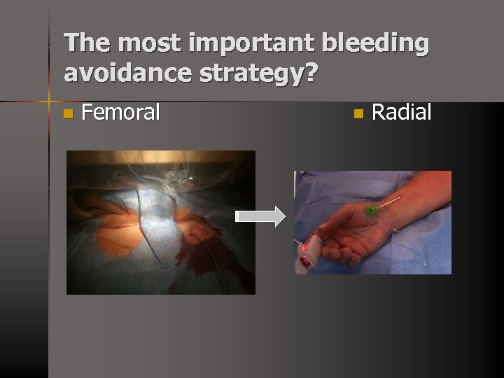 The most important bleeding avoidance strategy? n Femoral n Radial 
