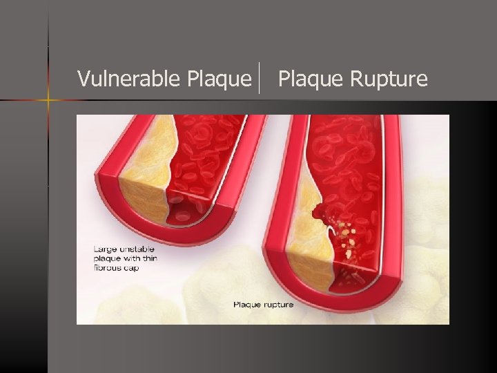 Vulnerable Plaque Rupture 