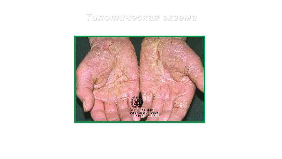 Тилотическая экзема 