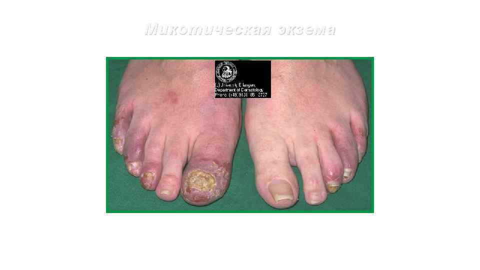 Микотическая экзема 