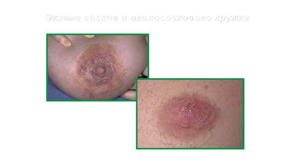 Экзема сосков и околососкового кружка 