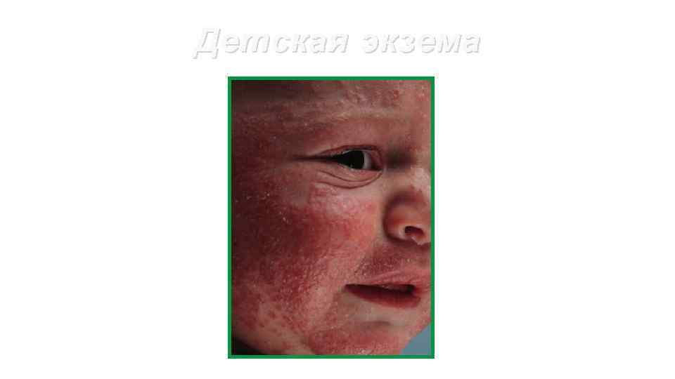 Детская экзема 