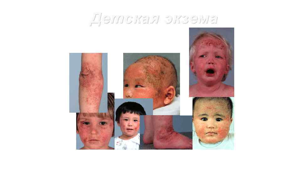 Детская экзема 