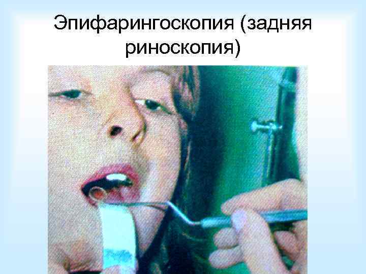 Эпифарингоскопия (задняя риноскопия) 