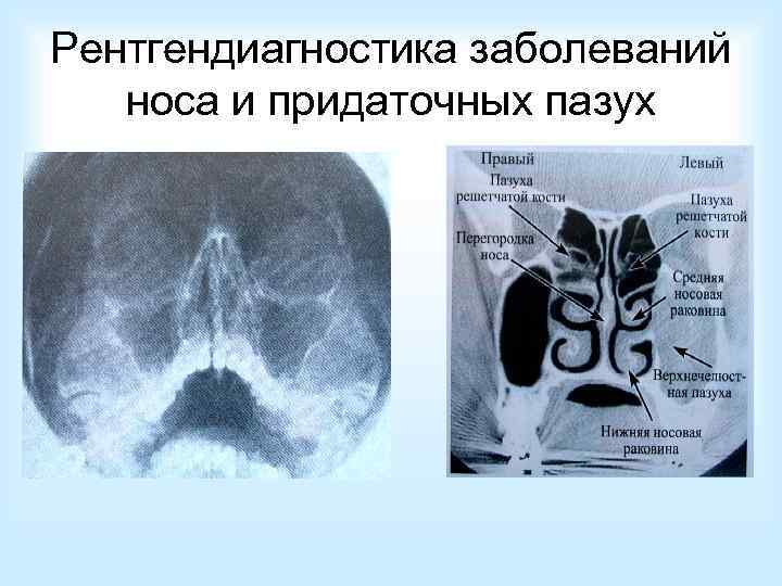 Рентгендиагностика заболеваний носа и придаточных пазух 