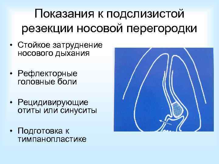 Показания к подслизистой резекции носовой перегородки • Стойкое затруднение носового дыхания • Рефлекторные головные