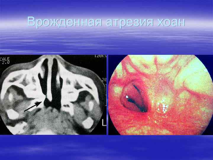 Врожденная атрезия хоан 