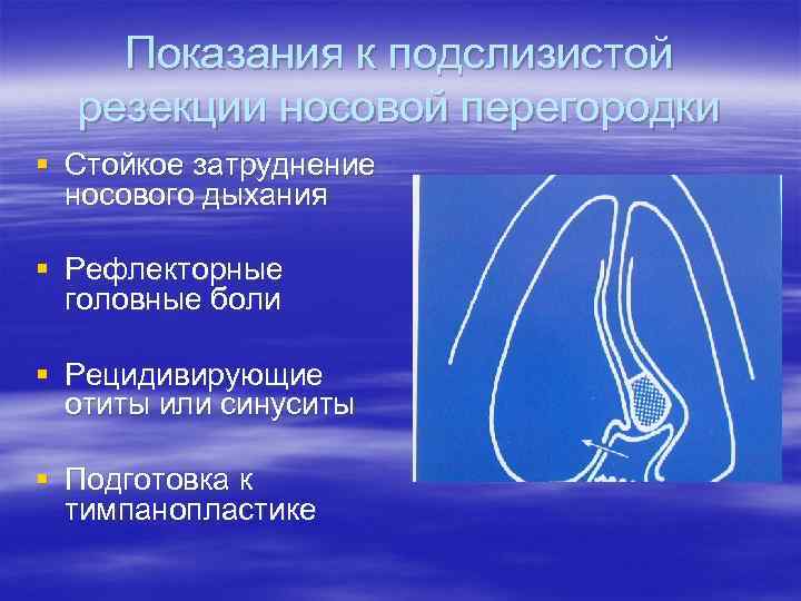 Показания к подслизистой резекции носовой перегородки § Стойкое затруднение носового дыхания § Рефлекторные головные