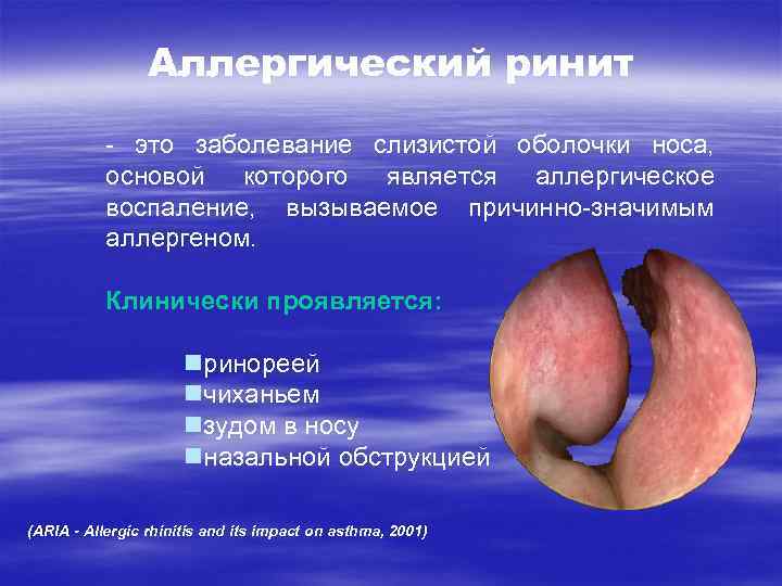 Аллергический ринит - это заболевание слизистой оболочки носа, основой которого является аллергическое воспаление, вызываемое