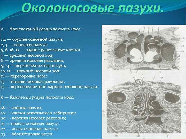 Околоносовые пазухи. а — фронтальный разрез полости носа: 1, 4 — соустье основной пазухи;