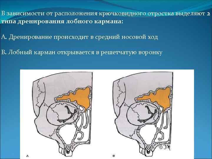 В зависимости от расположения крючковидного отростка выделяют 2 типа дренирования лобного кармана: A. Дренирование