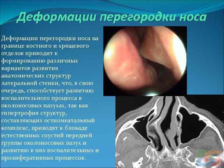 Деформации перегородки носа на границе костного и хрящевого отделов приводит к формированию различных вариантов