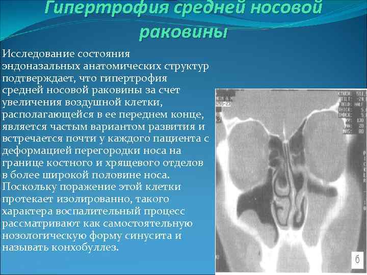 Гипертрофия средней носовой раковины Исследование состояния эндоназальных анатомических структур подтверждает, что гипертрофия средней носовой