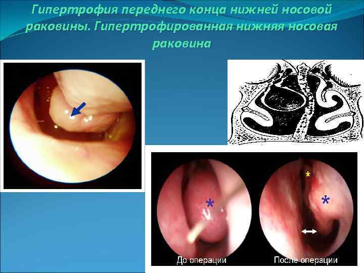 Гипертрофия переднего конца нижней носовой раковины. Гипертрофированная нижняя носовая раковина 