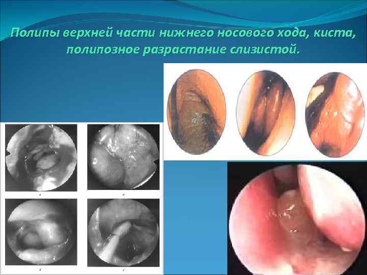 Полипы верхней части нижнего носового хода, киста, полипозное разрастание слизистой. 