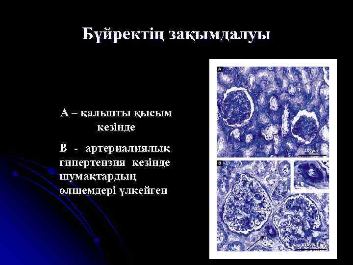 Бүйректің зақымдалуы А – қалыпты қысым кезінде В - артериалиялық гипертензия кезінде шумақтардың өлшемдері