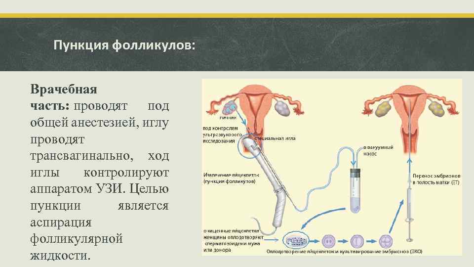 Пункция фолликулов: Врачебная часть: проводят под общей анестезией, иглу проводят трансвагинально, ход иглы контролируют