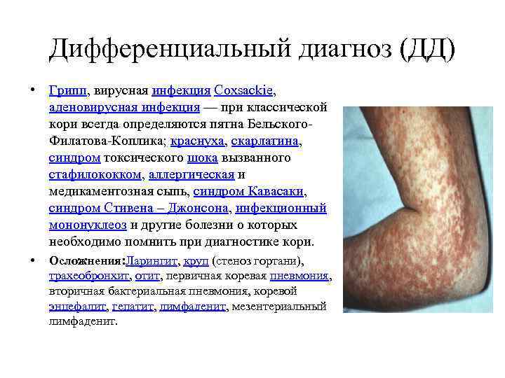 Дифференциальный диагноз (ДД) • Грипп, вирусная инфекция Coxsackie, аденовирусная инфекция — при классической кори