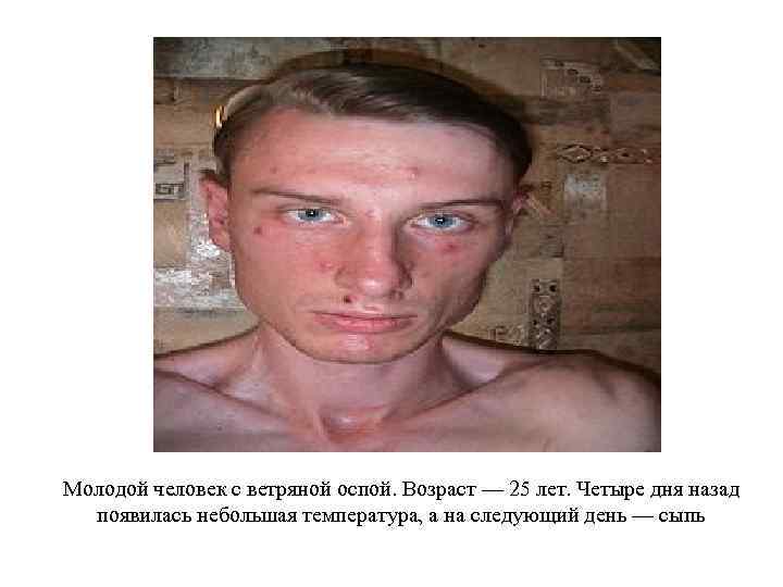 Молодой человек с ветряной оспой. Возраст — 25 лет. Четыре дня назад появилась небольшая