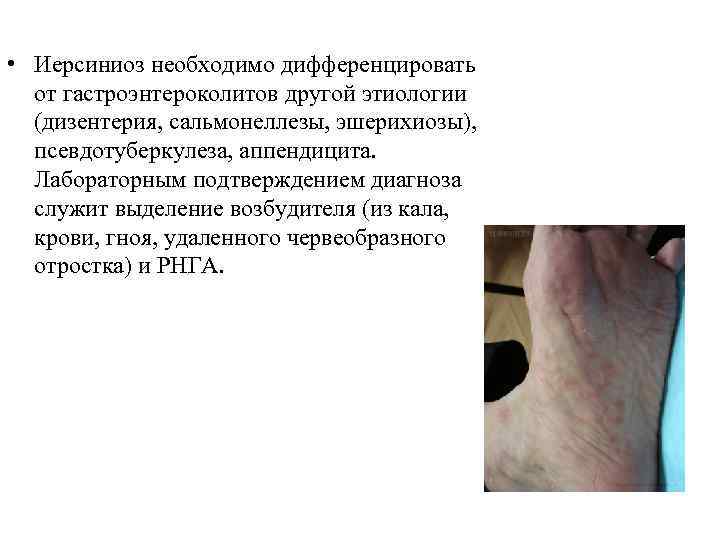  • Иерсиниоз необходимо дифференцировать от гастроэнтероколитов другой этиологии (дизентерия, сальмонеллезы, эшерихиозы), псевдотуберкулеза, аппендицита.