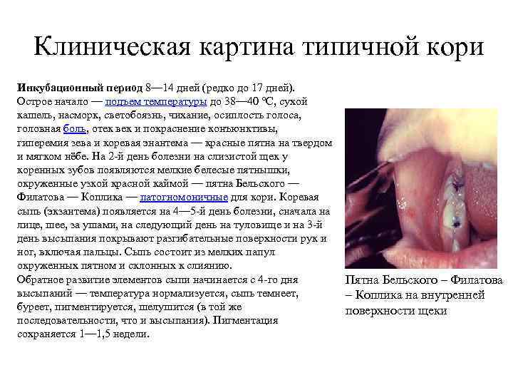Клиническая картина типичной кори Инкубационный период 8— 14 дней (редко до 17 дней). Острое
