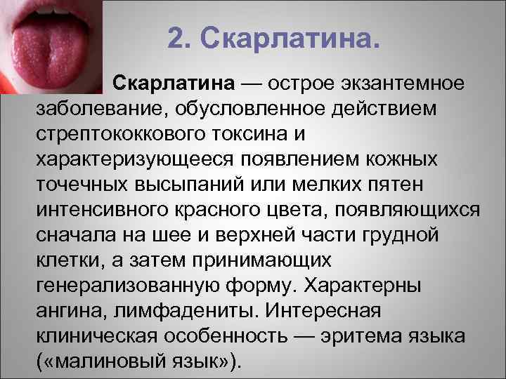2. Скарлатина. ¢ Скарлатина — острое экзантемное заболевание, обусловленное действием стрептококкового токсина и характеризующееся