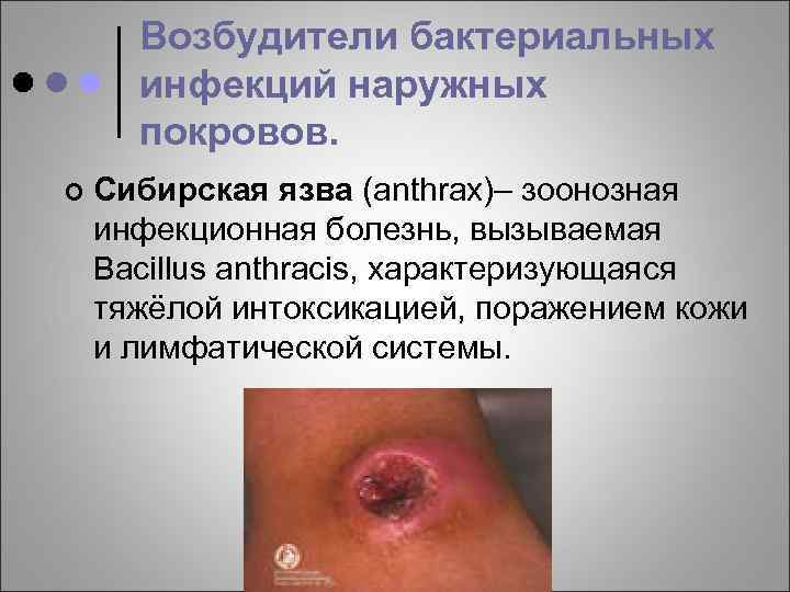 Возбудители бактериальных инфекций наружных покровов. ¢ Сибирская язва (anthrax)– зоонозная инфекционная болезнь, вызываемая Bacillus
