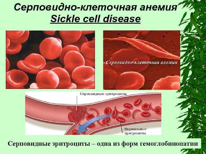 Серповидно-клеточная анемия Sickle cell disease Серповидные эритроциты – одна из форм гемоглобинопатии 