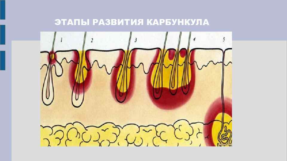 ЭТАПЫ РАЗВИТИЯ КАРБУНКУЛА 