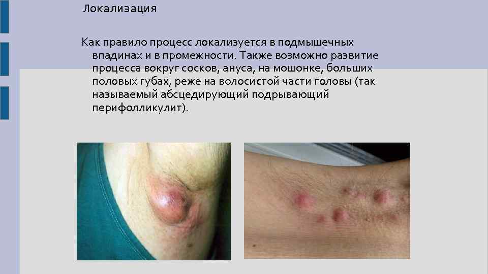 Локализация Как правило процесс локализуется в подмышечных впадинах и в промежности. Также возможно развитие