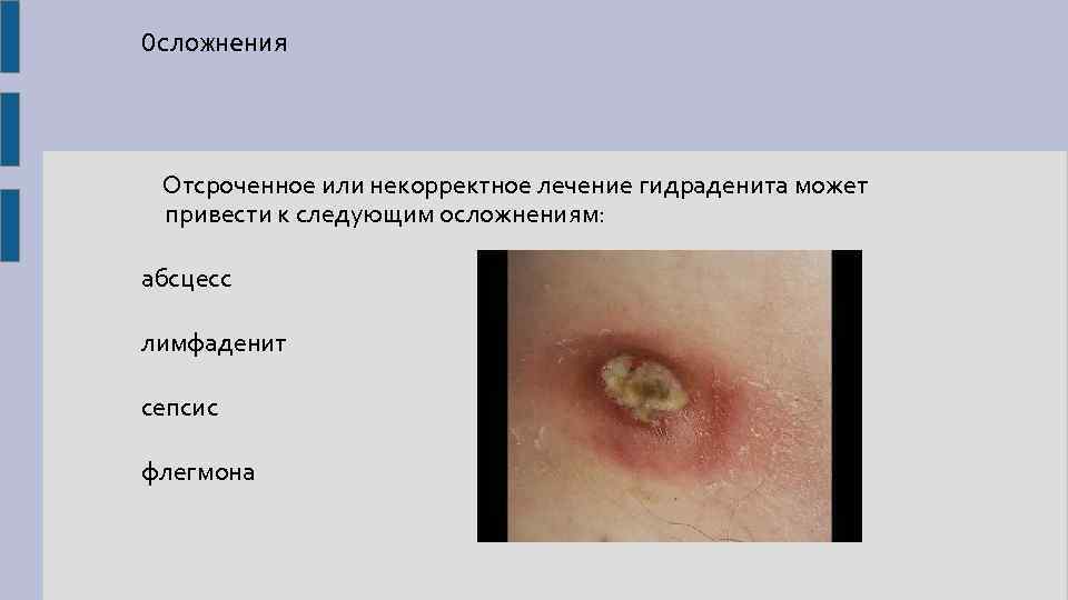Осложнения Отсроченное или некорректное лечение гидраденита может привести к следующим осложнениям: абсцесс лимфаденит сепсис