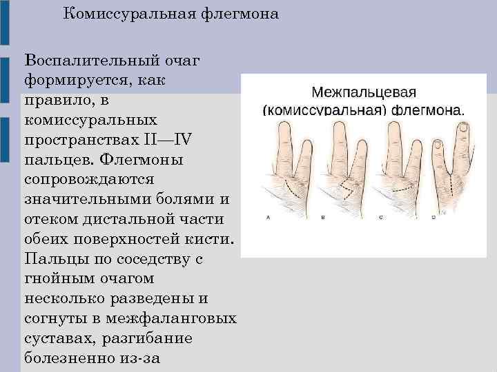 Флегмона кисти карта вызова